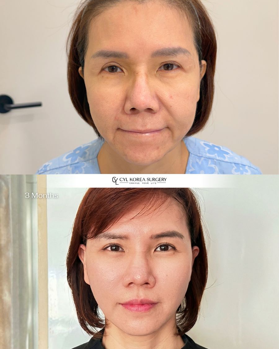 Anti-aging before and after photo 1 — CYL Korea Surgery