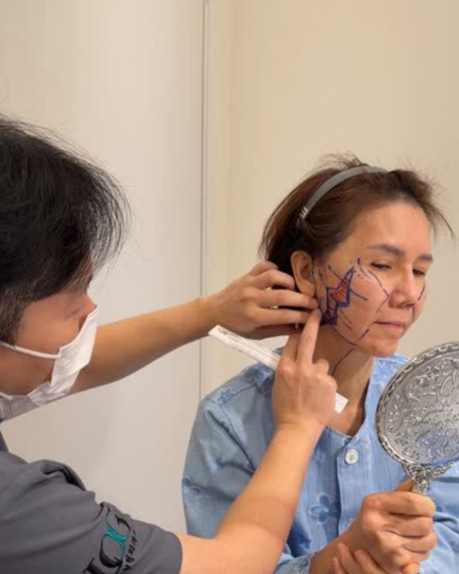 Anti-aging before and after photo 2 — CYL Korea Surgery