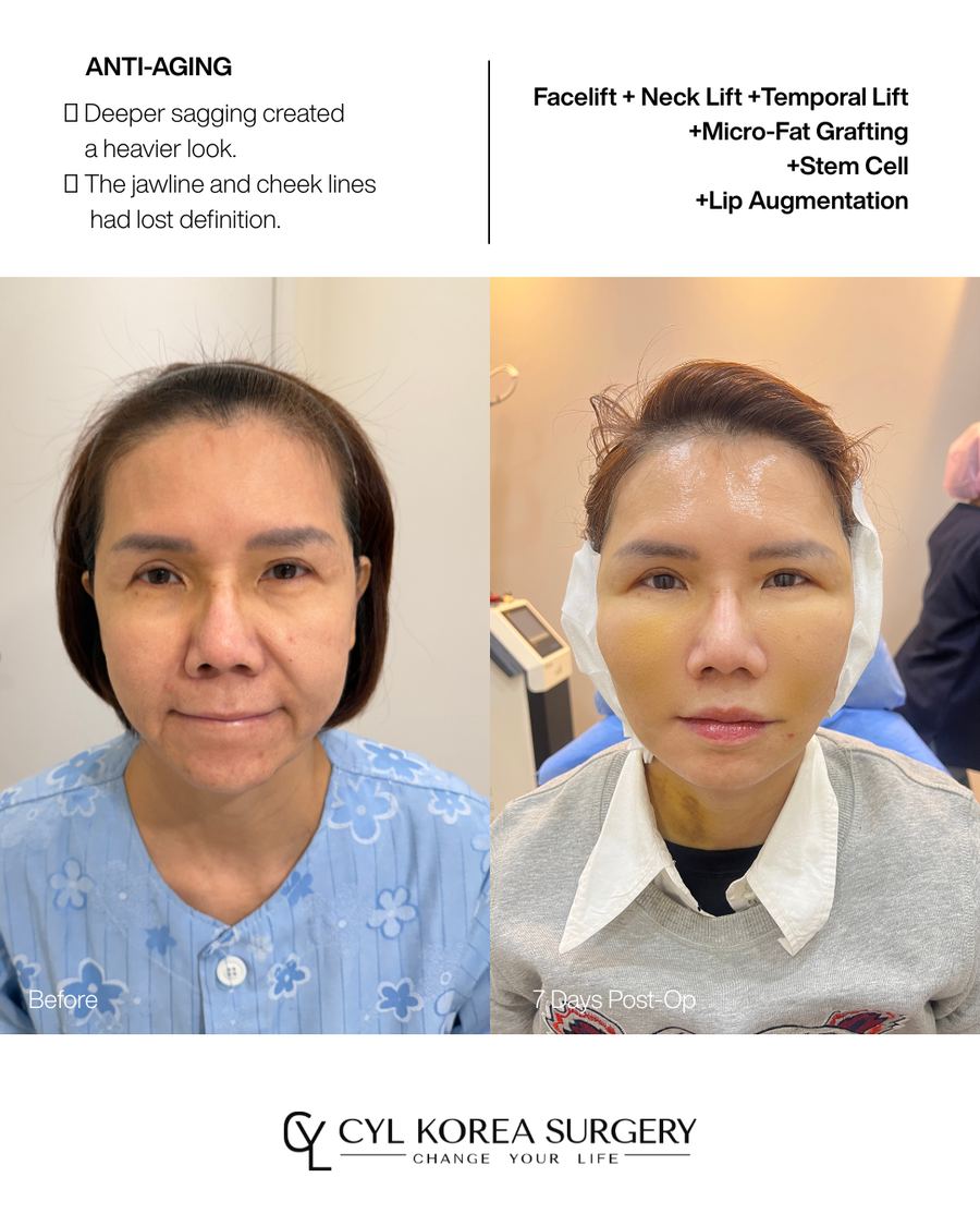 Anti-aging before and after photo 3 — CYL Korea Surgery