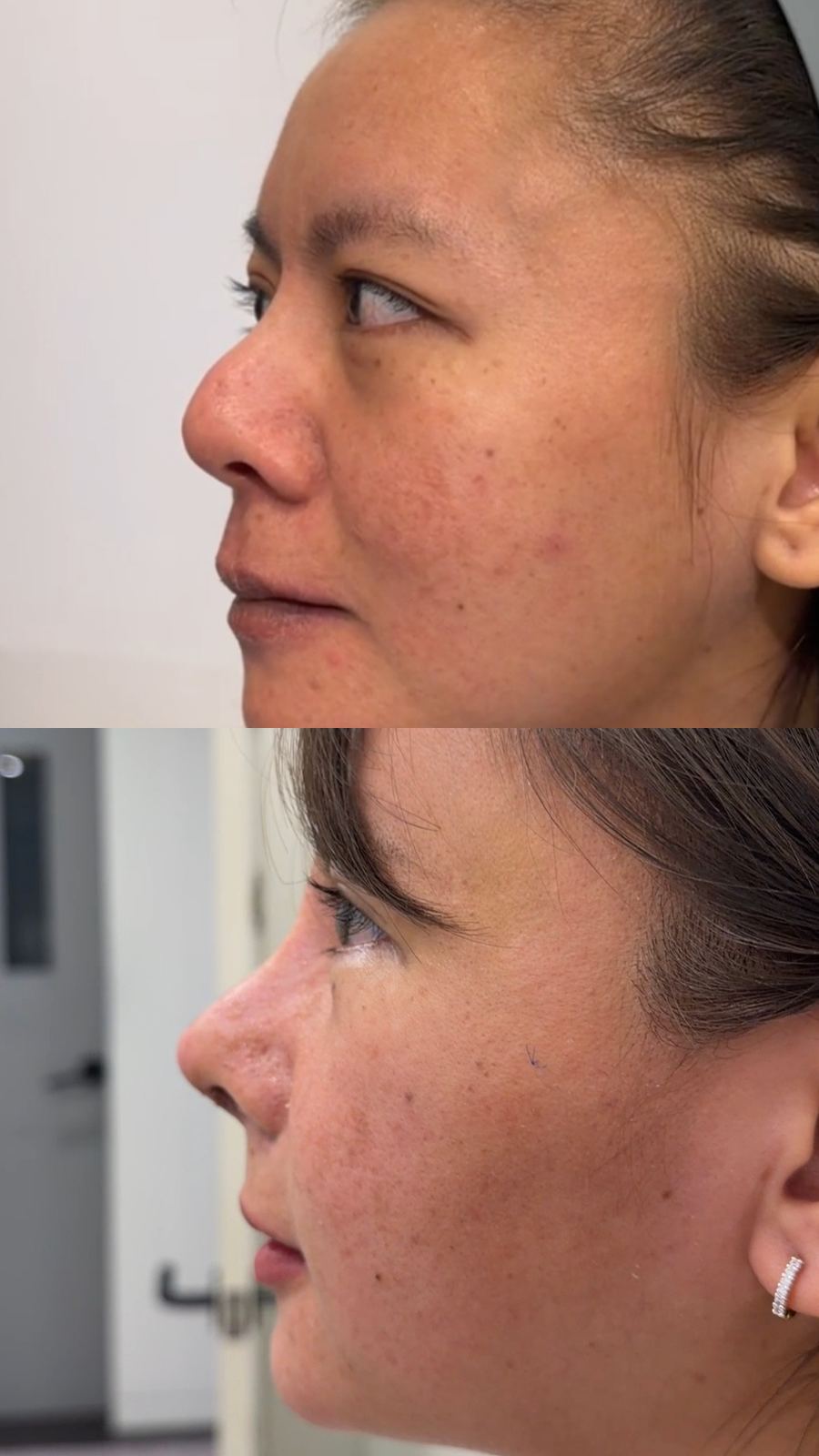 Anti-aging & Rhinoplasty before and after photo 1 — CYL Korea Surgery