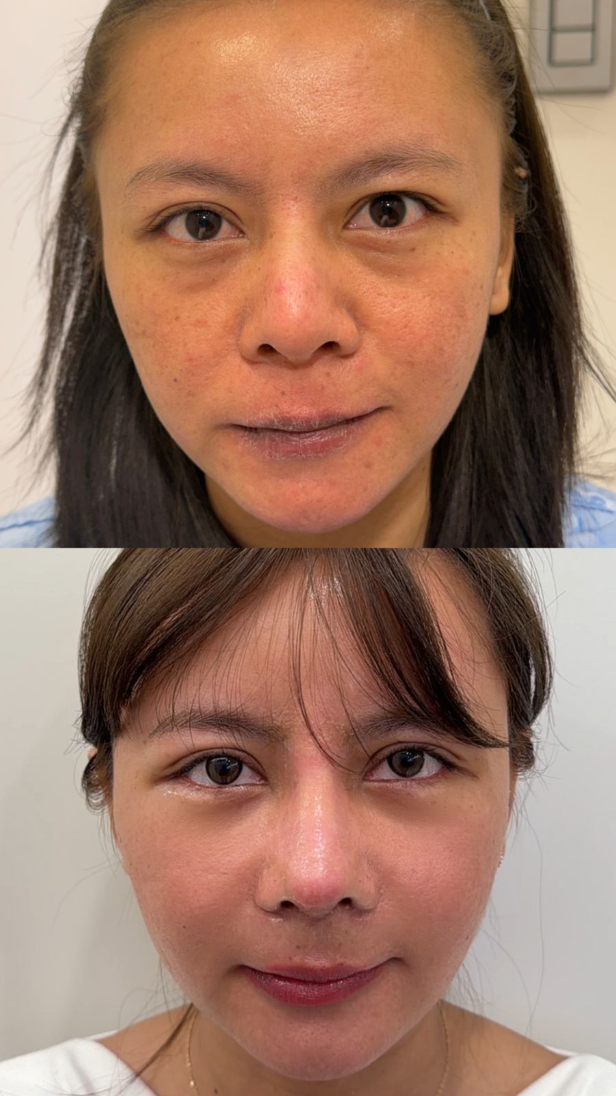Anti-aging & Rhinoplasty before and after photo 2 — CYL Korea Surgery