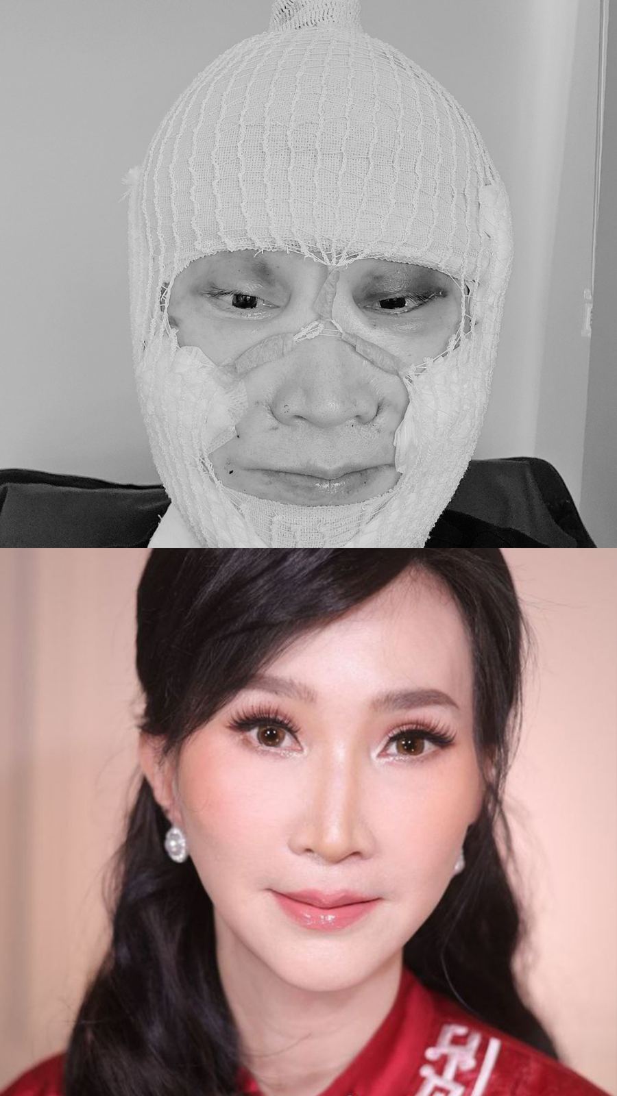 Anti-aging before and after photo 1 — CYL Korea Surgery