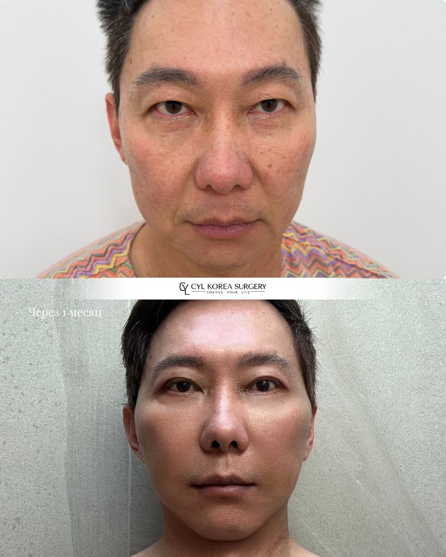 Men's Anti-aging before and after photo 1 — CYL Korea Surgery