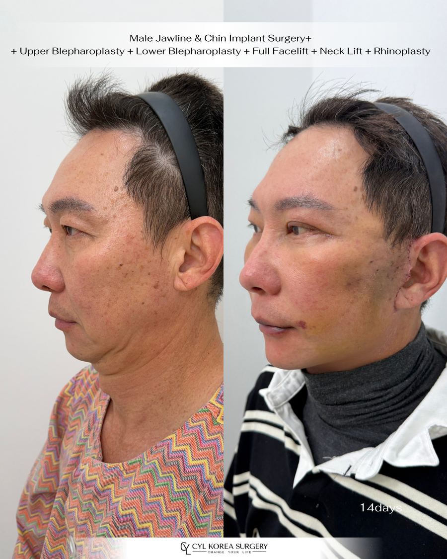 Men's Anti-aging before and after photo 3 — CYL Korea Surgery