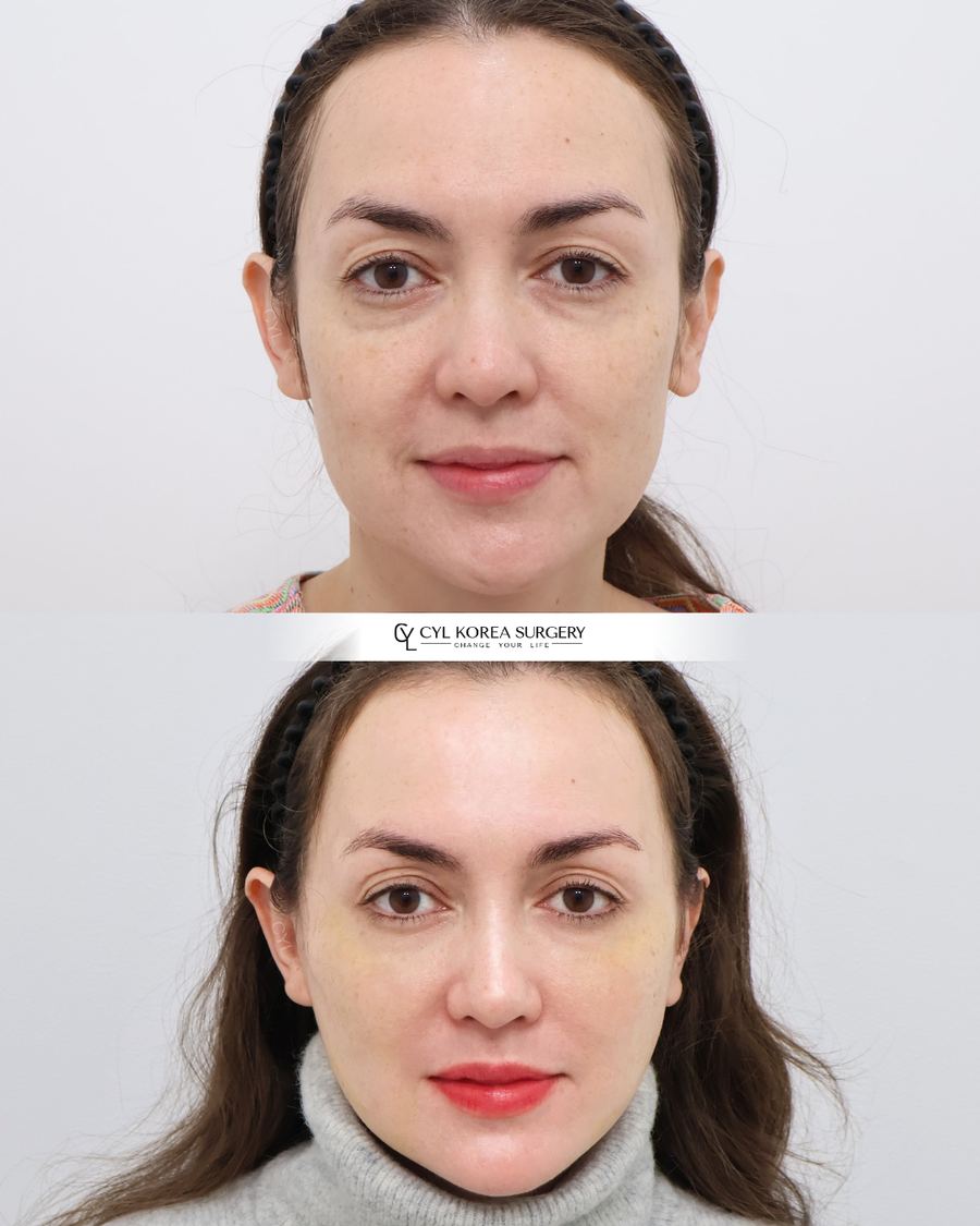 Anti-aging before and after photo 1 — CYL Korea Surgery