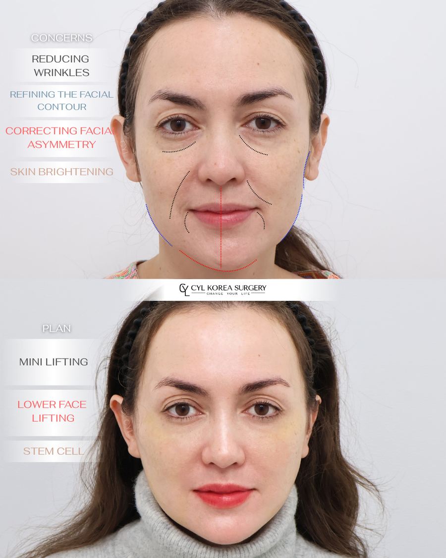 Anti-aging before and after photo 11 — CYL Korea Surgery