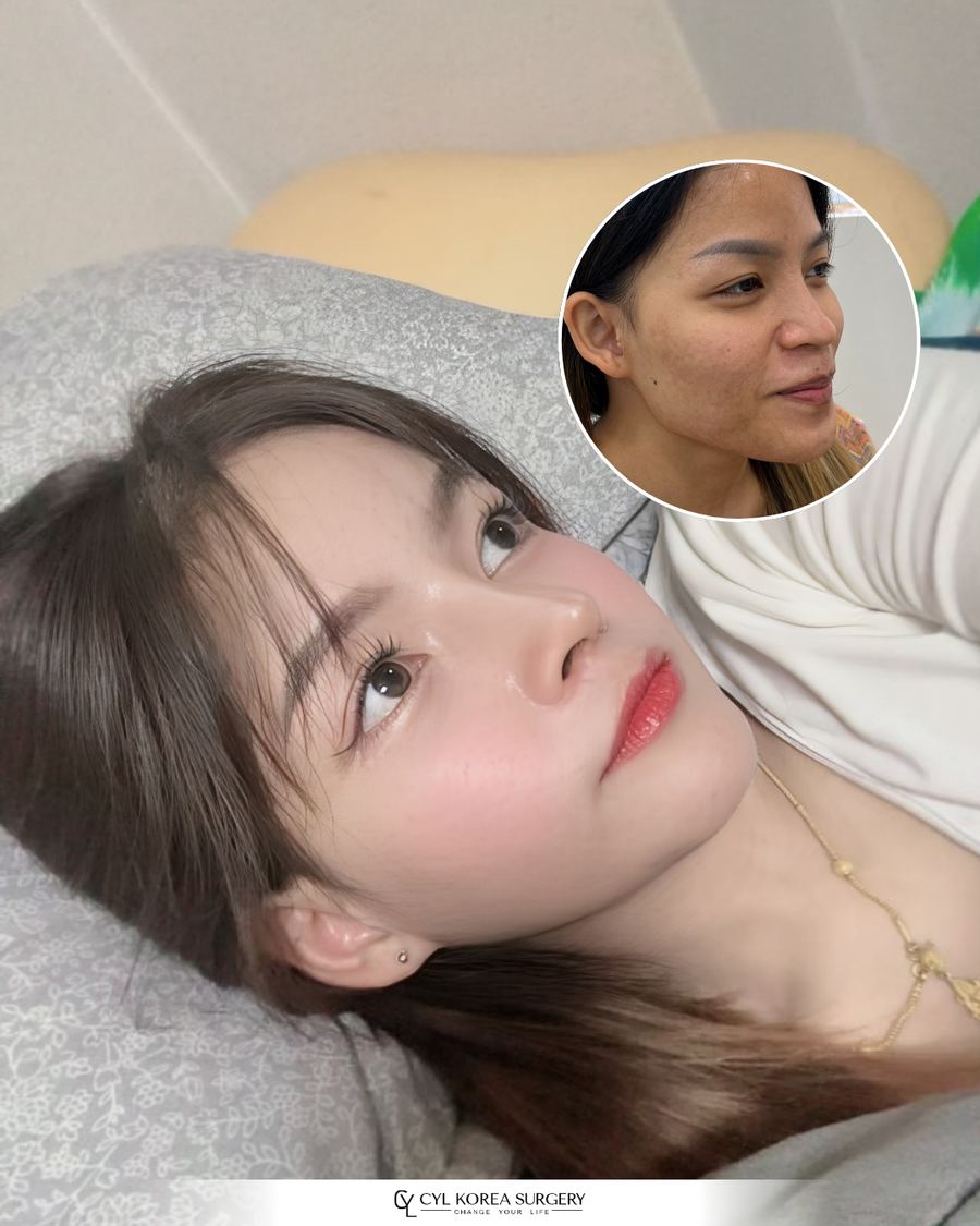 Facial Contouring & Rhinoplasty before and after photo 1 — CYL Korea Surgery