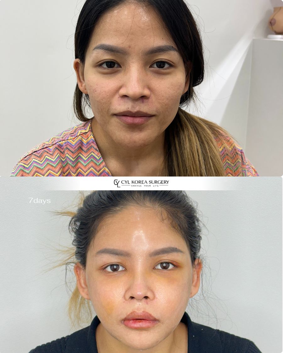 Facial Contouring & Rhinoplasty before and after photo 2 — CYL Korea Surgery