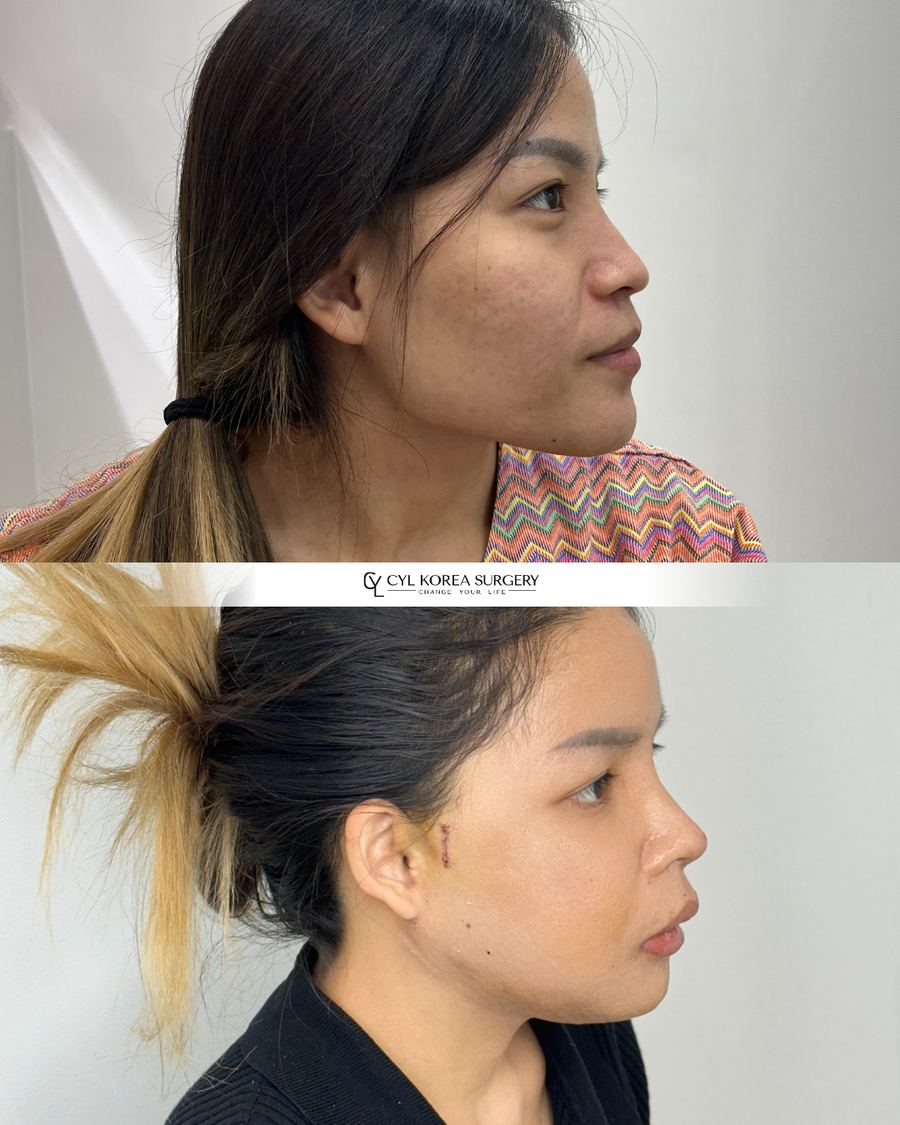 Facial Contouring & Rhinoplasty before and after photo 3 — CYL Korea Surgery