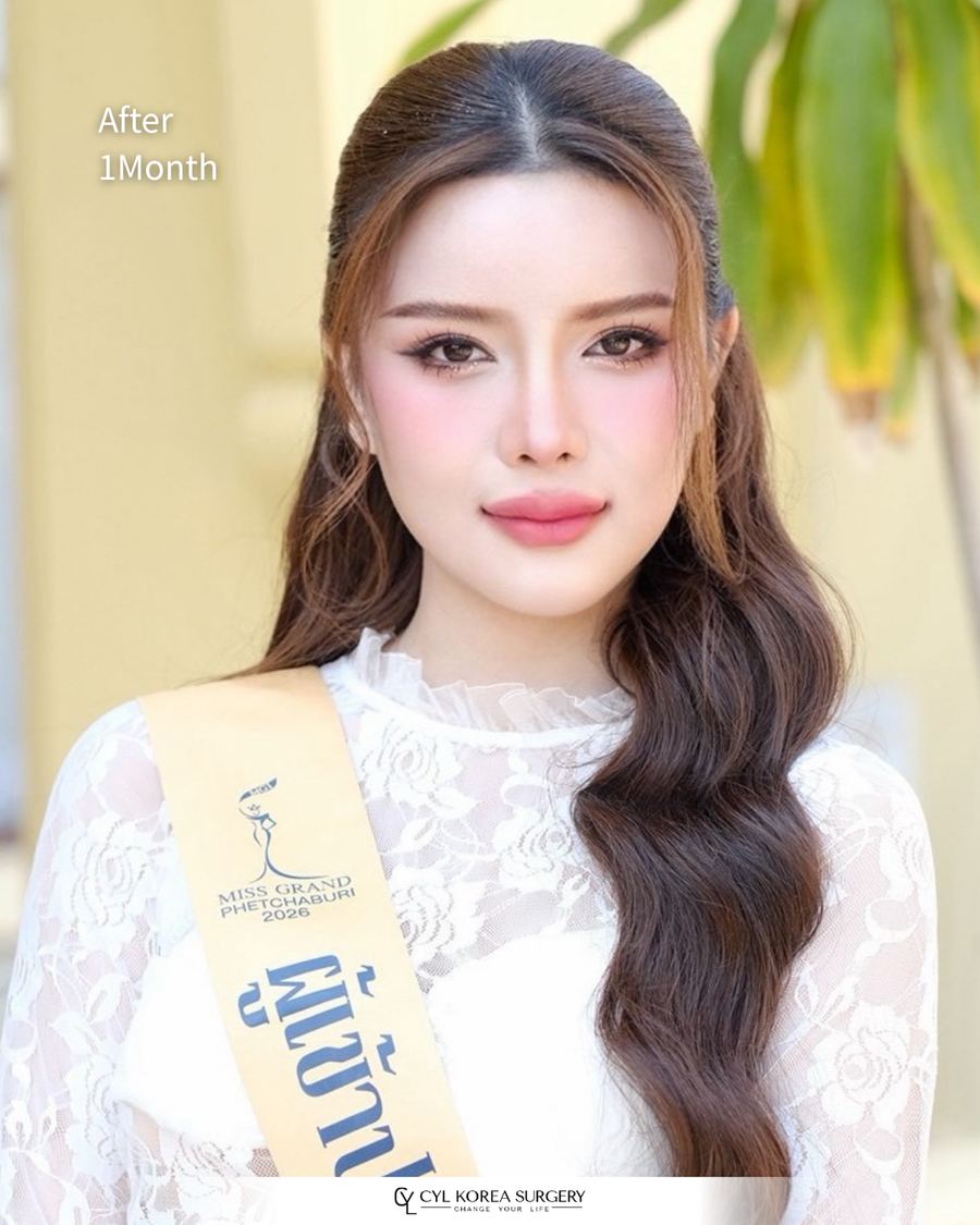 Facial Contouring before and after photo 2 — CYL Korea Surgery
