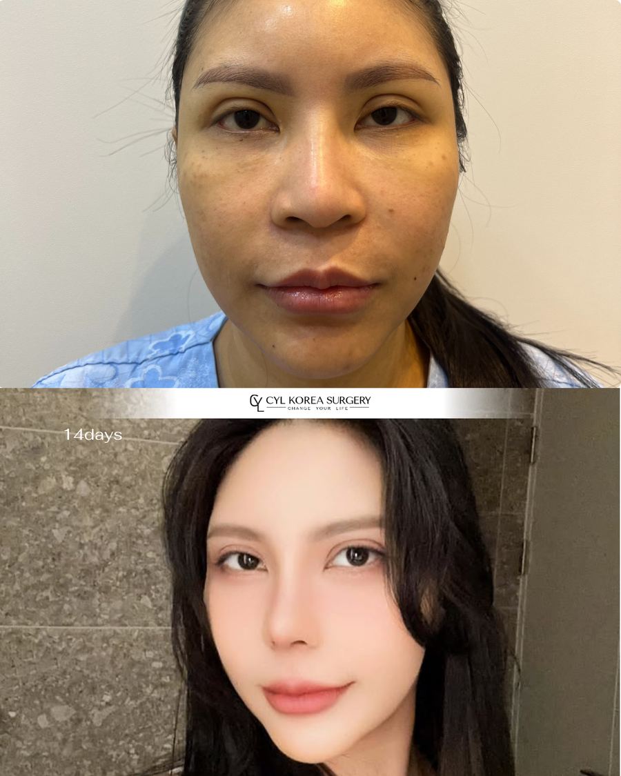 Rhinoplasty before and after photo 1 — CYL Korea Surgery