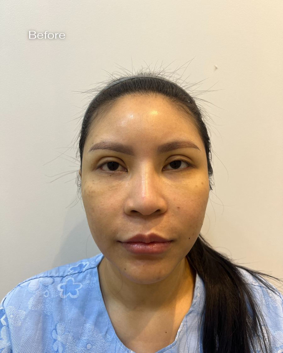 Rhinoplasty before and after photo 2 — CYL Korea Surgery