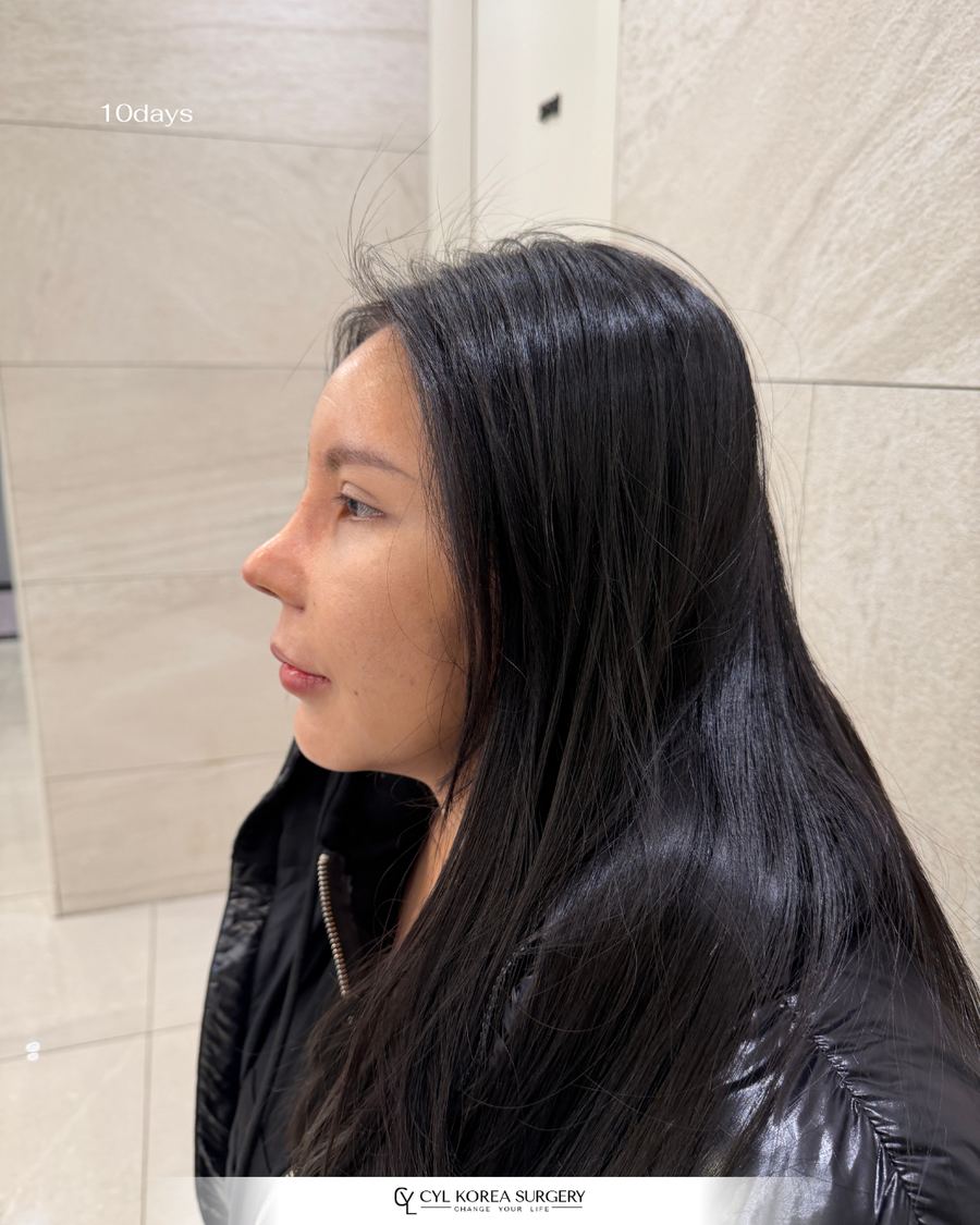Rhinoplasty before and after photo 3 — CYL Korea Surgery