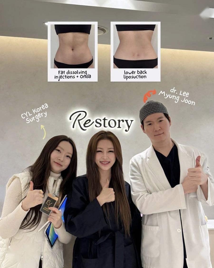 Body Liposuction before and after photo 1 — CYL Korea Surgery
