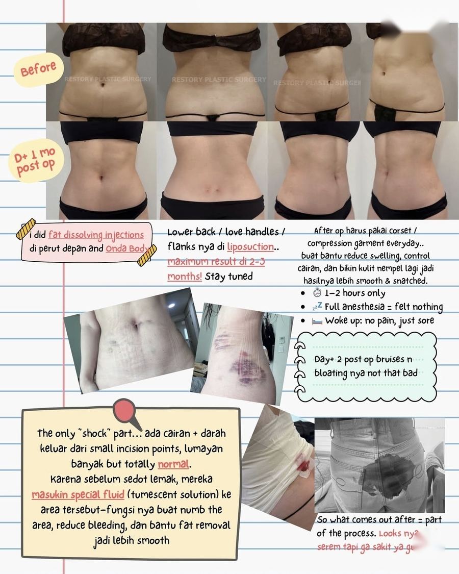 Body Liposuction before and after photo 4 — CYL Korea Surgery