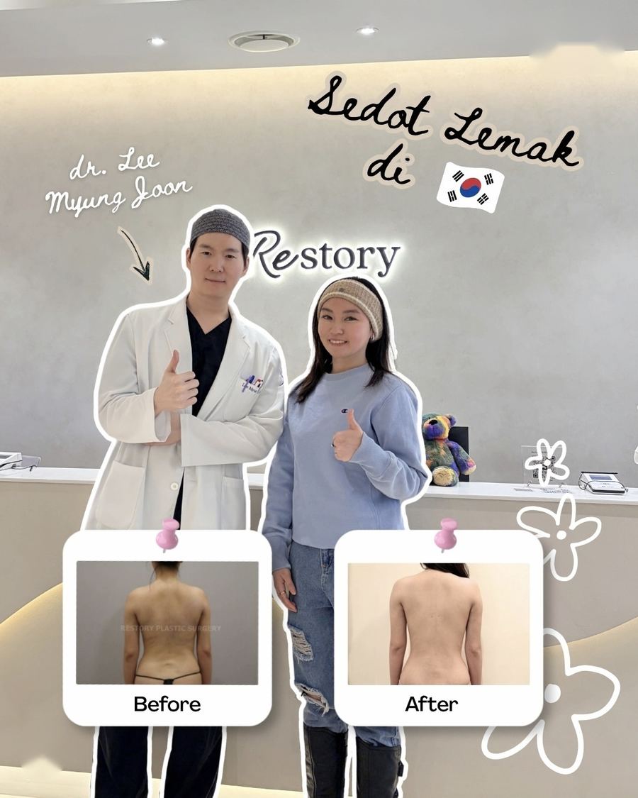 Body Liposuction before and after photo 1 — CYL Korea Surgery
