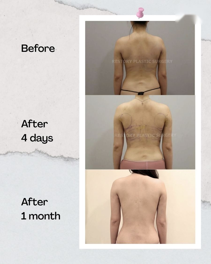 Body Liposuction before and after photo 2 — CYL Korea Surgery
