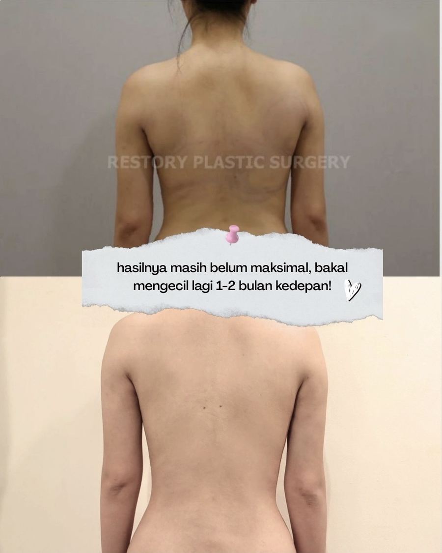 Body Liposuction before and after photo 3 — CYL Korea Surgery