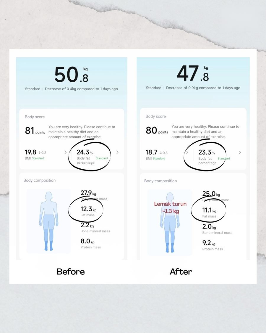 Body Liposuction before and after photo 6 — CYL Korea Surgery
